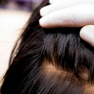 Профессиональное уничтожение вшей в Краснотурьинске