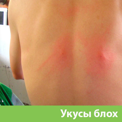Укусы блох в Краснотурьинске