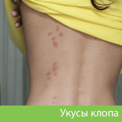 Профессиональное уничтожение клопов в Краснотурьинске